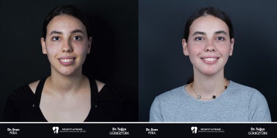 18-24 year old woman treated with Jaw Surgery, Genioplasty - Our patient with complaints of a gummy smile, facial asymmetry, and a long face underwent a surgery-first approach with bimaxillary orthognathic surgery and genioplasty.Here, you can see the patients appearance before surgery and 2 months postoperatively. The orthognathic planning was performed by Dr. Tugce Gurbuzturk , and the patients orthodontic treatment (Invisalign) is ongoing.