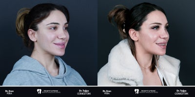 25-34 year old woman treated with Jaw Surgery, Genioplasty, V Line Surgery - Double jaw surgery is performed to correct the misalignment between the upper and lower jaws, balance facial aesthetics, and address functional issues such as chewing and speaking difficulties. The remarkable aesthetic and functional transformation of our patient once again proves the importance of meticulous planning and expert execution.