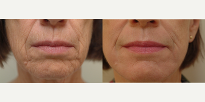 55-64 year old woman treated with Laser Resurfacing - Fractional Laser, one treatment.