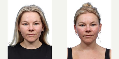 Woman treated with Skin Tightening with XERF - Woman treated with Skin Tightening with XERF
