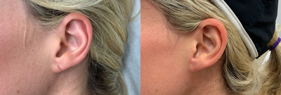 Woman treated with Earlobe Surgery - Woman treated with Earlobe Surgery.