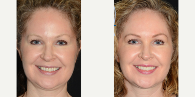 35-44 year old woman treated with Microblading - Microblading treatment of the eyebrows.