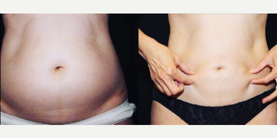 Woman treated with Vaser Liposuction - Woman treated with Vaser Liposuction
