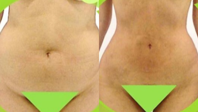 35-44 year old woman treated with Liposculpture - This is a liposculpture with Laser Vaser technique.