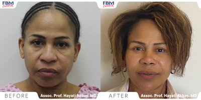 45-54 year old woman treated with Deep Plane Facelift, Double Eyelid Surgery, Facial Fat Transfer - This patient was suffering from puffy eyebags , saggy skin and needed to have more rejuvenated look . Double eyelids surgery, Face neck lift and lip lift were applied at the same operation.
