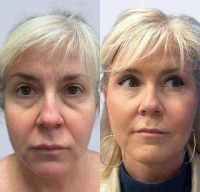 Woman treated with Facelift - Timeless transformation! A facelift offers several benefits in rejuvenating the appearance of the face. By tightening underlying muscles and removing excess tissue, I can provide long-lasting results.