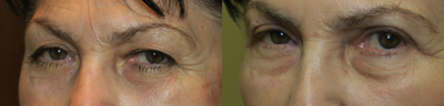 45-54 year old woman treated with Eyelid Surgery - upper blepharoplasty