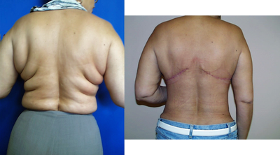 back lift in female patient - 	back lift in female patient