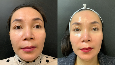 25-34 year old woman treated with Enlighten - Enlighten Peel5 Weeks Post Treatment Photo.