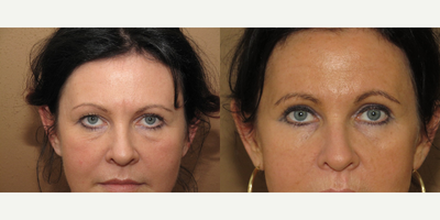45-54 year old woman treated with Eyelid Surgery - 45 yo female underwent upper and lower blepharoplasty