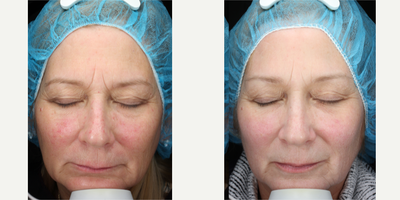 65-74 year old woman treated with Neo Laser - 65-74 year old woman treated with Neo Laser