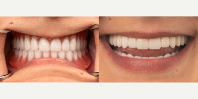 55-64 year old woman treated with All-on-4 Dental Implants, Dental Implants - This patient had been struggling with uncomfortable dentures that slipped, irritated their gums, and limited what they could eat. After switching to a custom full arch dental implant solution, they now have a secure, permanent smile that looks and feels natural. No more adhesives, no more slipping, just confidence, comfort, and the freedom to enjoy life again.