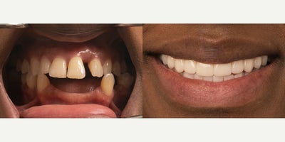 35-44 year old woman treated with All-on-4 Dental Implants, Dental Implants - This patient came to us with a mix of missing and broken teeth and was ready for a real, lasting solution. Through the All-On-X procedure, we restored their entire smile with a full arch of natural-looking, fixed teeth. Now they can eat comfortably, smile confidently, and enjoy life without worrying about dental issues.
