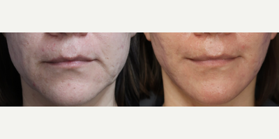 Woman treated with Facelift, Neck Lift - Revealing the faceology md secret to a radiant glow...A FACEology LIFT has given this patient a newfound confidence!Swipe to see the stunning transformation