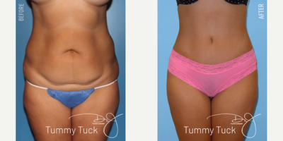 Woman treated with Butt Lift - Woman treated with Natural Butt Lift as well as Tummy Tuck