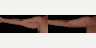 Arm lift at 1 month post-op - The patient had a major weight loss and was concerned about the extra skin on her arms.