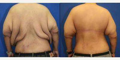 35-44 year old man treated with Back Lift - This is a male patient who went through significant weight loss. He was not happy with the skin and fat in his back area. He underwent a horizontal torsoplasty, also known as upper back lift. Notice how much smoother and smaller his back is. He no longer has excess skin and fat in his back. This patient is very happy with his torsoplasty results.