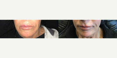 Woman treated with Lip Surgery - Woman treated with Lip Surgery