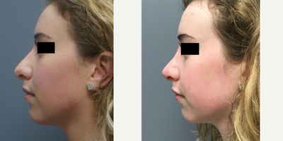 18-24 year old woman treated with Rhinoplasty - At just 1 month Post-Op, this lovely open rhinoplasty patient already has amazing results! And there is still swelling present (especially in the tip), so these results can only improve!