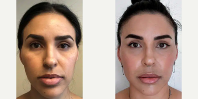 35-44 year old woman treated with Jaw Surgery - 35-44 year old woman treated with Jaw Surgery