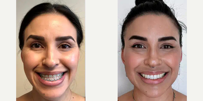 35-44 year old woman treated with Jaw Surgery - 35-44 year old woman treated with Jaw Surgery