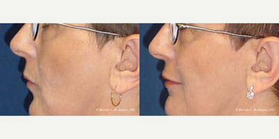 Lip Augmentation - Lip Augmentation