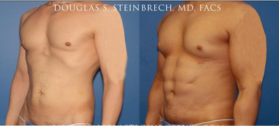 Man treated with Bicep Implants - Man treated with Bicep Implants