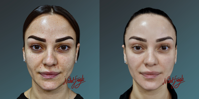 35-44 year old woman treated with Fraxel Laser - 35-44 year old woman treated with Fraxel Laser