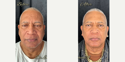 65-74 year old man treated with Emface - Before & After 4 sessions of EMFACE