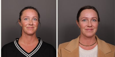 35-44 year old female treated with BroadBand Light (BBL), Moxi, Lip Fillers - 2 BBL and Moxi treatments by Katherine Small, and a half syringe of lip filler by Moriah Carr. Age 38. 1 month post-treatment.