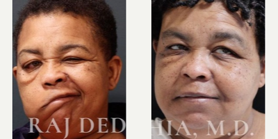 Woman treated with Facial Reconstructive Surgery - Facial Reanimation/Smile RestorationThis patient suffered from facial paralysis and the inability to smile after a stroke. She underwent a complex facial reanimation surgery with nerve transfers to improve facial function and symmetry.