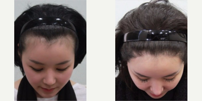 18-24 year old woman treated with Forehead Reduction - Forehead Reduction