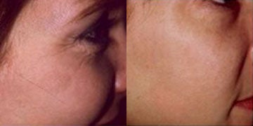 glutathione reverse aging Before and After Glutathione: How This Antioxidant Affects Skin, Aging