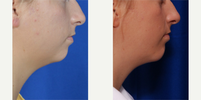 25-34 year old woman treated with Chin Implant in New Orleans - Patient seeking enhancement of chin projection. Sean R. Weiss, MD placed medium sized chin implant.
