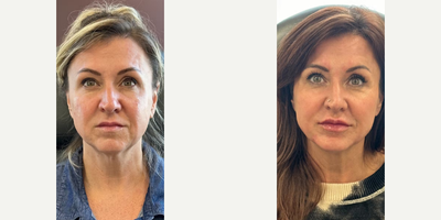Woman treated with Dermal Fillers - Woman treated with Dermal Fillers