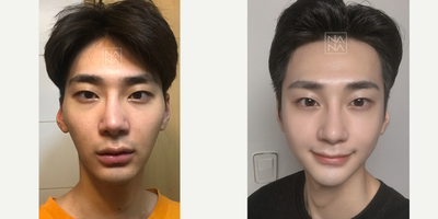 25-34 year old man treated with Asian Rhinoplasty, Cheekbone Reduction - Open- RhinoplastyCheekbone Reduction