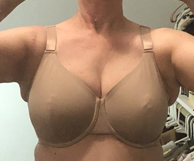 Long Overdue Breast Reduction 34G to 34B - Review - RealSelf