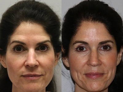 Juvederm - While many of our patients are quite active with various exercise activities everyday this lack of fat becomes evident in the face and leads to the appearance of aging.Here is very beautiful and successful bay area patient who underwent a filler treatment to her temples. She had Juvederm placed and she is thrilled with the results as I am. You can see the subtle softening and smooth transition from the temple to the cheek without a shadow or hollow. Following the treatment, you no longer see the outline of the brow bone or orbital rim youthful contours.