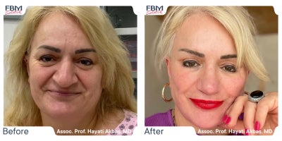 55-64 year old woman treated with Rhinoplasty, Facelift, Deep Plane Facelift, Facial Fat Transfer, Eyelid Surgery - 55-64 year old woman treated with Rhinoplasty, Facelift, Deep Plane Facelift, Facial Fat Transfer, Eyelid Surgery