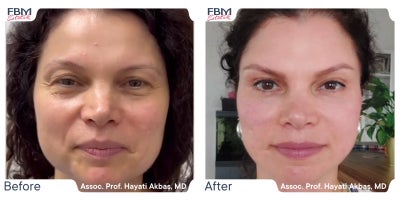 35-44 year old woman treated with Deep Plane Facelift, Facelift, Eyelid Surgery, Facial Fat Transfer - 35-44 year old woman treated with Deep Plane Facelift, Facelift, Eyelid Surgery, Facial Fat Transfer