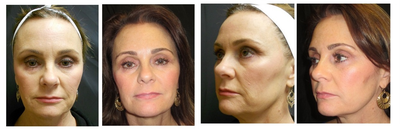 Ultherapy  - 