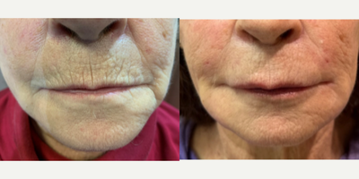 65-74 year old woman treated with Dermal Fillers - Using Dr. Song's signature HD HA filler technique, we can help to smooth out pesky etched lines that appear in places like above the lips.