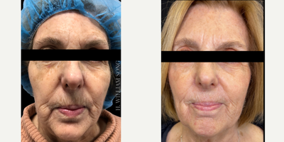 55-64 year old woman treated with Vampire Facelift - Using PRP and BellaFill, we can replace lost volume, while producing collagen for long lasting results!
