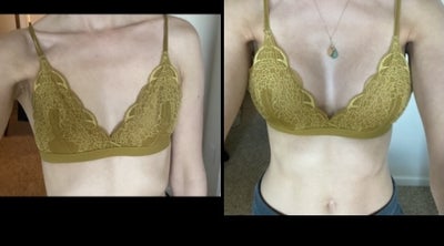 Harrington + Associates - 32A ⏭ 32C breast augmentation transformation to  give this patient a natural fullness. Feeling confident is the most  important thing, and if it's surgery you need, we are