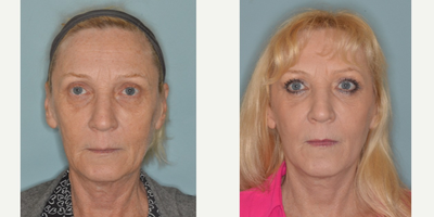 55-64 year old woman treated with Facelift - Here's a female patient's before and after photo's following a facelift, lower eyelid blepharoplasty, Sculptra, and laser resurfacing.