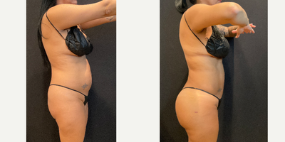 35-44 year old woman treated with Brazilian Butt Lift, Rib Removal, Abdominal Etching - Rib Repositioning, BBL, and HD Lipo by Dr. Franco