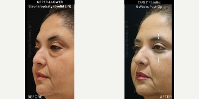 UPPER & LOWER Blepharoplasty (Eyelid Lift Surgery) | Undereye Bags | Bulging | Fat Herniation | Loose Excess Skin | Look Tired | - My patient had SEVERE lower eyelid bags that were getting worse over time. She also had excess upper eyelid skin. She was constantly being told she looks tired and she wanted to rejuvenate her face to get a more youthful appearance before her wedding in a few weeks! She was MOST bothered by her eyelids. - - - To correct her problems, I performed an upper and lower blepharoplasty (eyelid lift). - - - She required:  Precise removal of her excess UPPER eyelid skin, carefully hiding the scar in her natural eyelid crease (so it would heal invisibly)  Careful removal of the herniated LOWER eyelid bulging fat (which cause the lower lid bags)  Suspension of the ORBICULARIS muscle to the bony orbital rim- to restore the muscle anatomy to a more natural position and decrease the likelihood of recurrent bulging after surgery  Delicate suture placement to close the incisions in such a way that they heal properly and the final scars are basically invisible - - - Her case highlights why you should ONLY trust your face with an experienced Facial Plastic Surgeon! 