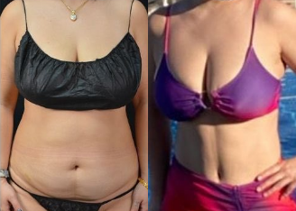 Woman treated with Tummy Tuck - Woman treated with Tummy Tuck