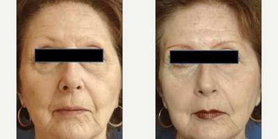 Woman treated with IPL - Woman treated with IPL