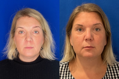 Submental Smart Lipo Precision TX - 48 year old patient 6 weeks post submental Smart Lipo Precision TX